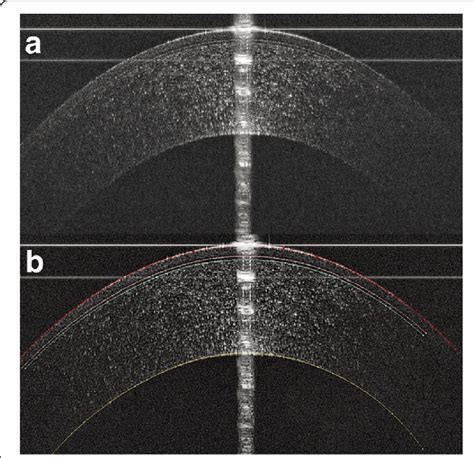 measuring corneal thickness with oct|normal cornea decenterion.